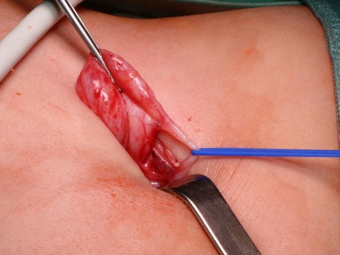 exteriorise