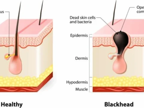 blackhead