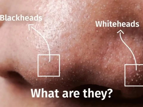 whitehead