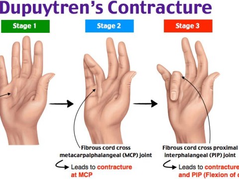 contracture
