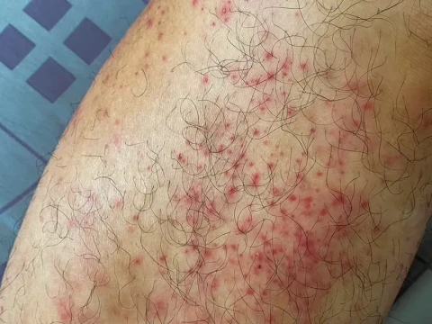hives