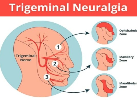 neuralgia