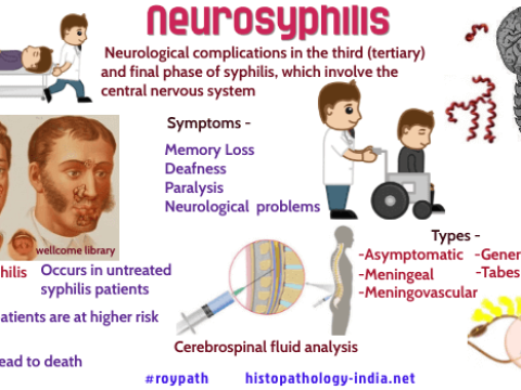 neurosyphilis