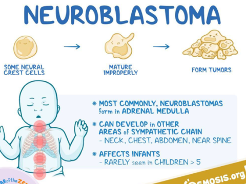 neuroblastoma
